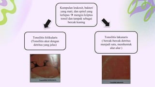 Tonsilitis lakunaris
( bercak-bercak detritus
menjadi satu, membentuk
alur-alur )
Tonsilitis folikularis
(Tonsilitis akut dengan
detritus yang jelas)
Kumpulan leukosit, bakteri
yang mati, dan epitel yang
terlepas  mengisi kriptus
tonsil dan tampak sebagai
bercak kuning
 