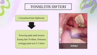Corynebacterium diphteriae
Tersering pada anak berusia
kurang dari 10 tahun, frekuensi
tertinggi pada usia 2-5 tahun
TONSILITIS DIFTERI
 