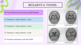 T0: tonsil dalam fossa tonsil atau telah diangkat
T1: besarnya ¼ arkus anterior –uvula
T2: besarnya ½ arkus anterior –uvula
T3: besarnya ¾ arkus anterior –uvula
T4: besarnya mencapai uvula atau lebih
BESARNYA TONSIL
 