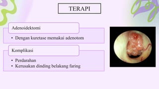 • Dengan kuretase memakai adenotom
Adenoidektomi
• Perdarahan
• Kerusakan dinding belakang faring
Komplikasi
TERAPI
 