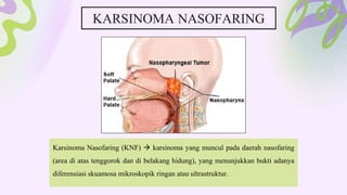 KARSINOMA NASOFARING
Karsinoma Nasofaring (KNF)  karsinoma yang muncul pada daerah nasofaring
(area di atas tenggorok dan di belakang hidung), yang menunjukkan bukti adanya
diferensiasi skuamosa mikroskopik ringan atau ultrastruktur.
 