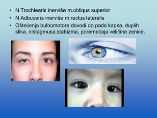 • N.Trochlearis inerviše m.obliqus superior
• N.Adbucens inerviše m.rectus lateralis
• Oštećenja bulbomotora dovodi do pada kapka, duplih
slika, nistagmusa,stabizma, poremećaja veličine zenice.
 