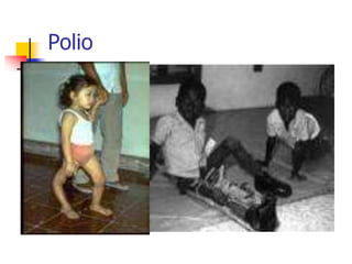 Polio
 