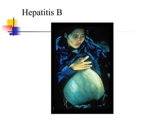 Hepatitis B
 