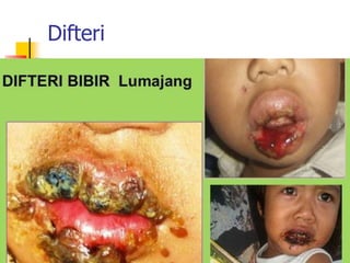 Difteri
 