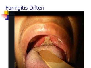 Faringitis Difteri
 
