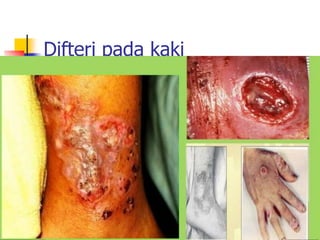 Difteri pada kaki
 
