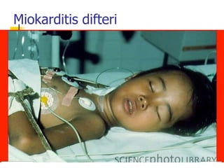 Miokarditis difteri
 