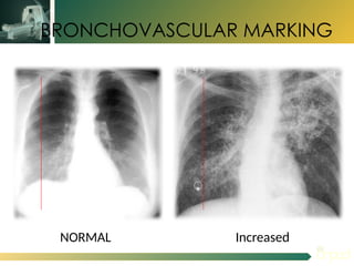 Bronkovascular Pattern ANATOMI THORAKS Basic for Radiologi.pptx