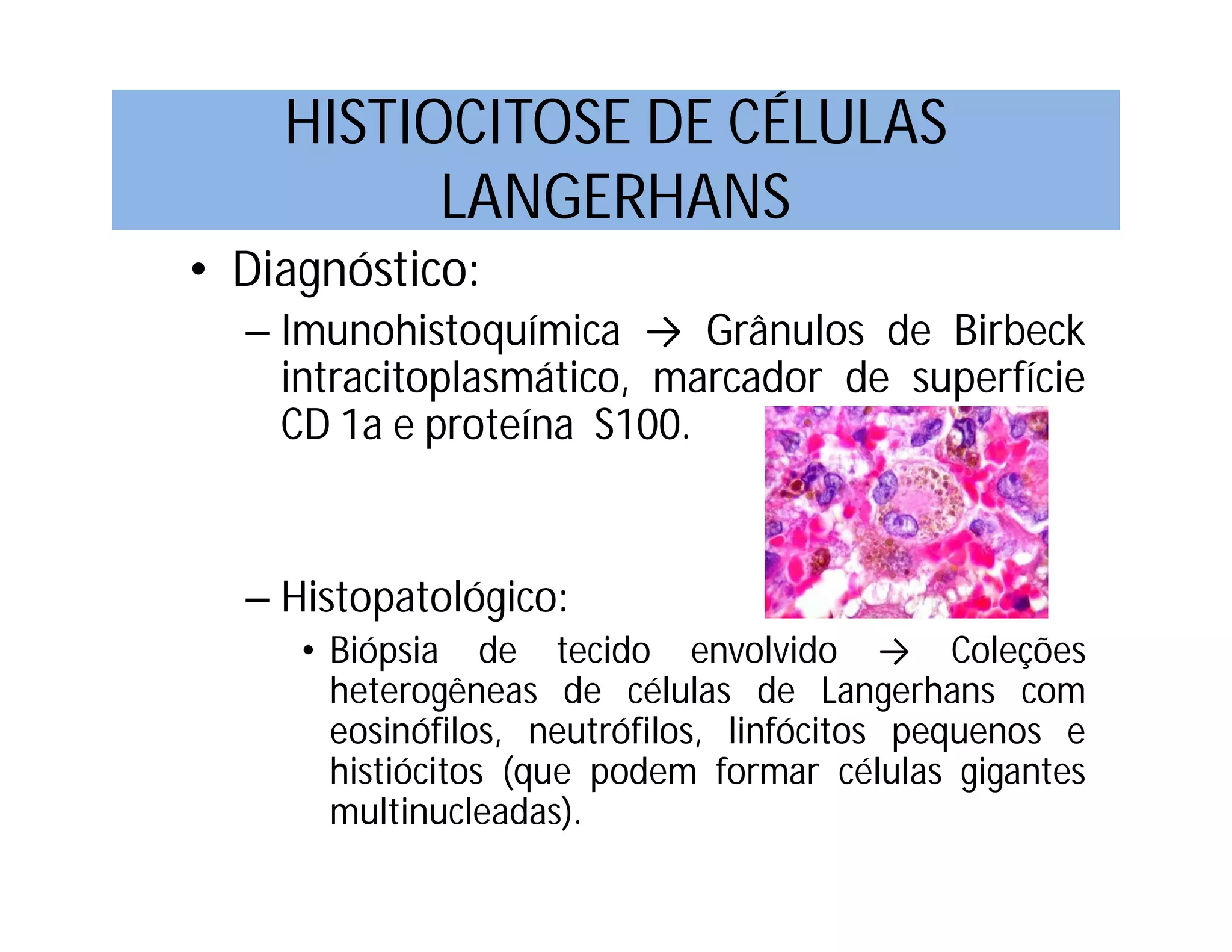 Histiocitose de Células de Langerhans | PDF