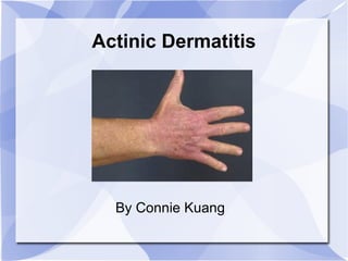 Actinic Dermatitis By Connie Kuang 