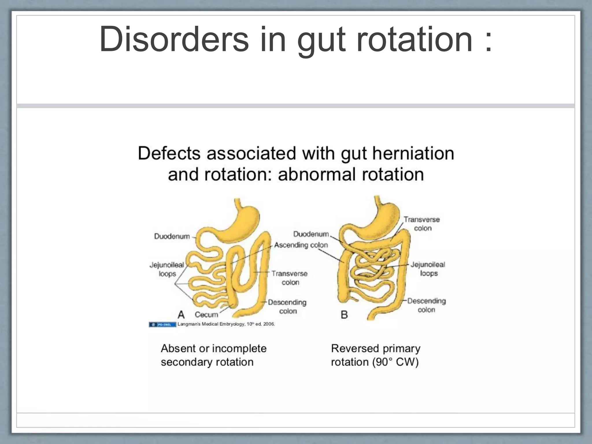 Disorders in gut rotation :
 