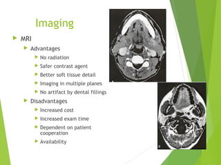 Imaging
 MRI
 Advantages
 No radiation
 Safer contrast agent
 Better soft tissue detail
 Imaging in multiple planes
 No artifact by dental fillings
 Disadvantages
 Increased cost
 Increased exam time
 Dependent on patient
cooperation
 Availability
 