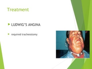 Treatment
 LUDWIG’S ANGINA
 required tracheostomy
 