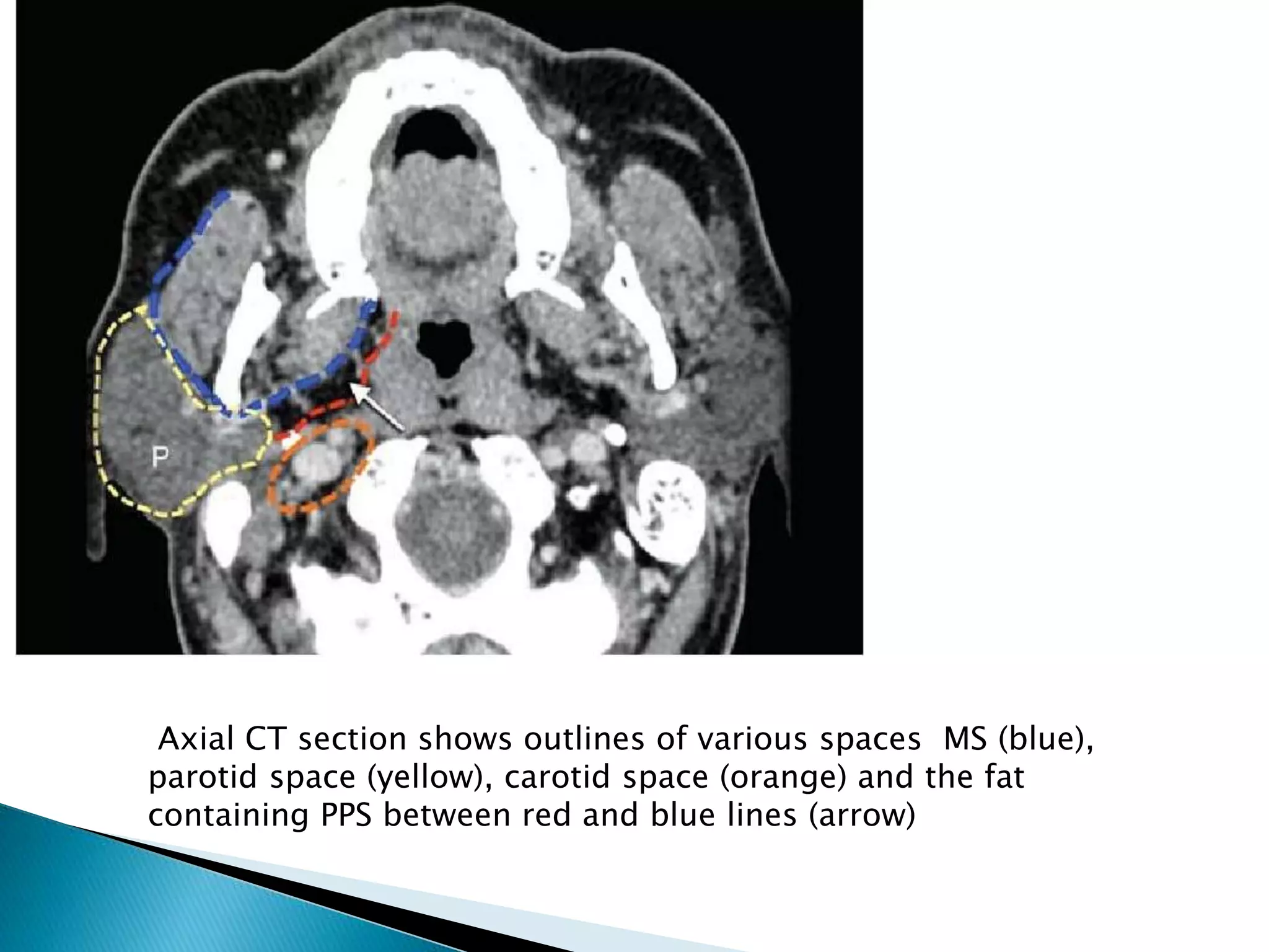 Radiological Anatomy Of Infra Temporal Fossa PPTX radiological-anatomy-of-infra-temporal-fossa-pptx