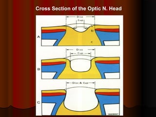 Cross Section of the Optic N. Head

 