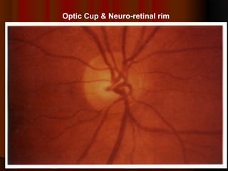 Optic Cup & Neuro-retinal rim

 