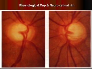 Physiological Cup & Neuro-retinal rim

 