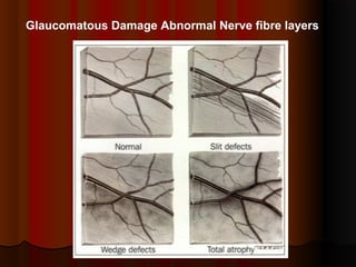 Glaucomatous Damage Abnormal Nerve fibre layers

 