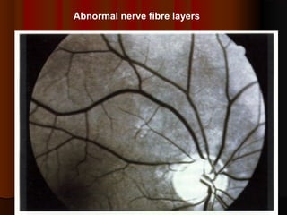 Abnormal nerve fibre layers

 