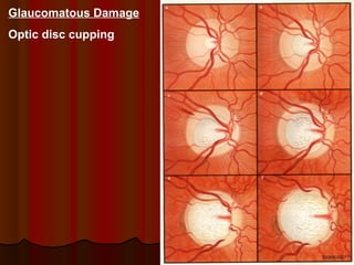 Glaucomatous Damage
Optic disc cupping

 