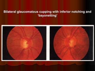 Bilateral glaucomatous cupping with inferior notching and
‘bayonetting’

 
