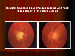 Bilateral advanced glaucomatous cupping with nasal
displacement of the blood vessels

 