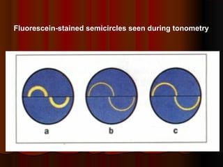 Fluorescein-stained semicircles seen during tonometry

 