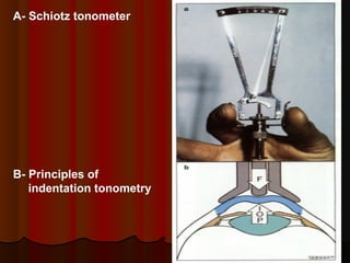 A- Schiotz tonometer

B- Principles of
indentation tonometry

 