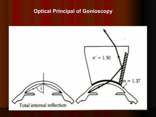 Optical Principal of Gonioscopy

 