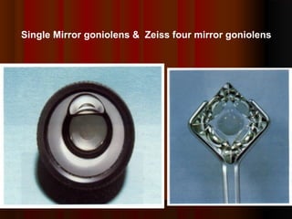 Single Mirror goniolens & Zeiss four mirror goniolens

 