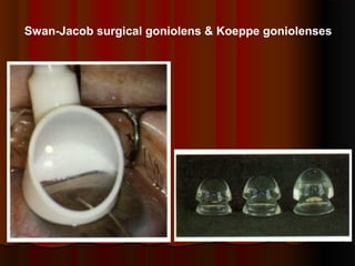 Swan-Jacob surgical goniolens & Koeppe goniolenses

 