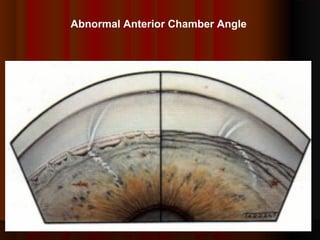 Abnormal Anterior Chamber Angle

 
