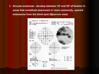 1. Arcuate scotomas : develop between 100 and 200 of fixation in
areas that constitute downward or more commonly, upward
extensions from the blind spot (Bjeerrum area)

 