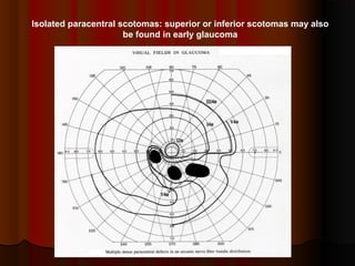 Isolated paracentral scotomas: superior or inferior scotomas may also
be found in early glaucoma

 