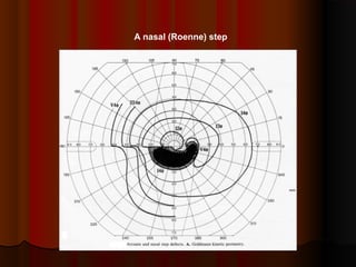A nasal (Roenne) step

 