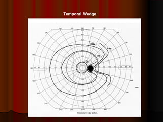 Temporal Wedge

 