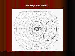 End Stage fields defects

 