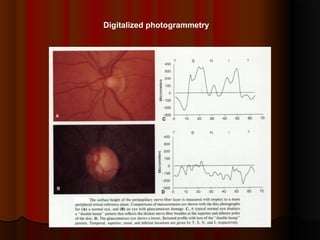 Digitalized photogrammetry

 