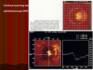 Confocal scanning laser
ophthalmoscope (HRT)

 