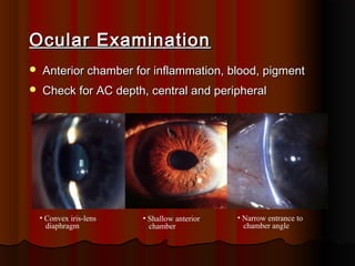 Ocular Examination


Anterior chamber for inflammation, blood, pigment



Check for AC depth, central and peripheral

• Convex iris-lens
diaphragm

• Shallow anterior
chamber

• Narrow entrance to
chamber angle

 