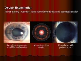 Ocular Examination
Iris for atrophy , rubeosis, trans-illumination defects and pseudoexfoliation

Stromal iris atrophy with
spiral-like configuration

Mid-peripheral iris
atrophy

Central disc with
peripheral band

 