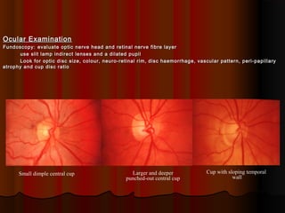 Ocular Examination
Fundoscopy: evaluate optic nerve head and retinal nerve fibre layer
use slit lamp indirect lenses and a dilated pupil
Look for optic disc size, colour, neuro-retinal rim, disc haemorrhage, vascular pattern, peri-papillary
atrophy and cup disc ratio

Small dimple central cup

Larger and deeper
punched-out central cup

Cup with sloping temporal
wall

 