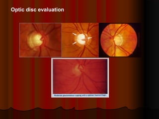 Optic disc evaluation

 