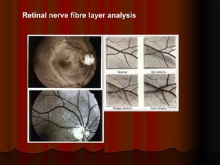 Retinal nerve fibre layer analysis

 