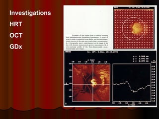 Investigations
HRT
OCT
GDx

 
