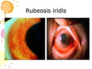 Negative Rubeosis Anatomy-and-diseases-of-the-uvea detailed slide share | PPT