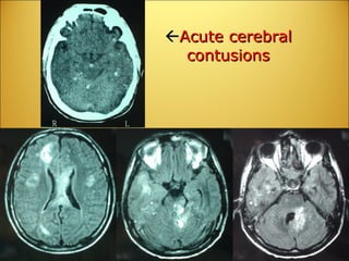  Acute cerebral contusions Two weeks after injury 