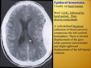 Epidural hematoma .  Usually s/p  head trauma . Brief  +LOC, followed by lucid period.  Then drowsy/coma/death . A well-defined  biconvex  collection of blood (arrows) compresses the left cerebral hemisphere. There is inward displacement of the grey-white junction (arrowheads) and slight rightward displacement of the left lateral ventricle. 