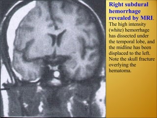 Right subdural hemorrhage revealed by MRI . The high intensity (white) hemorrhage has dissected under the temporal lobe, and the midline has been displaced to the left. Note the skull fracture overlying the hematoma. 